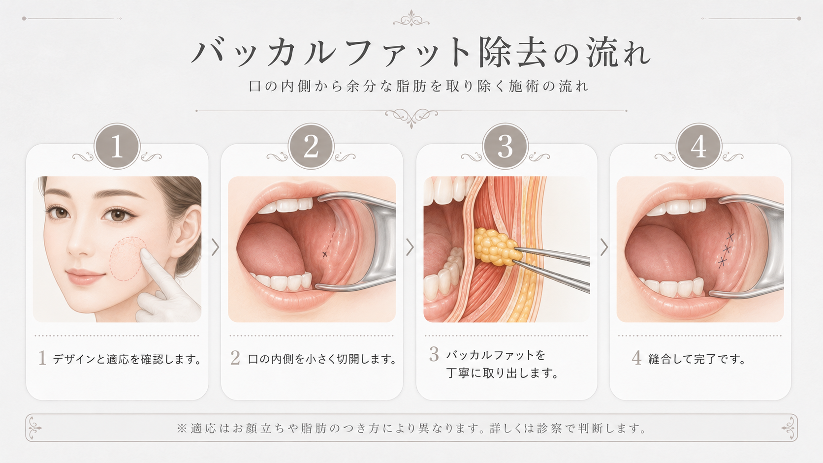 バッカル