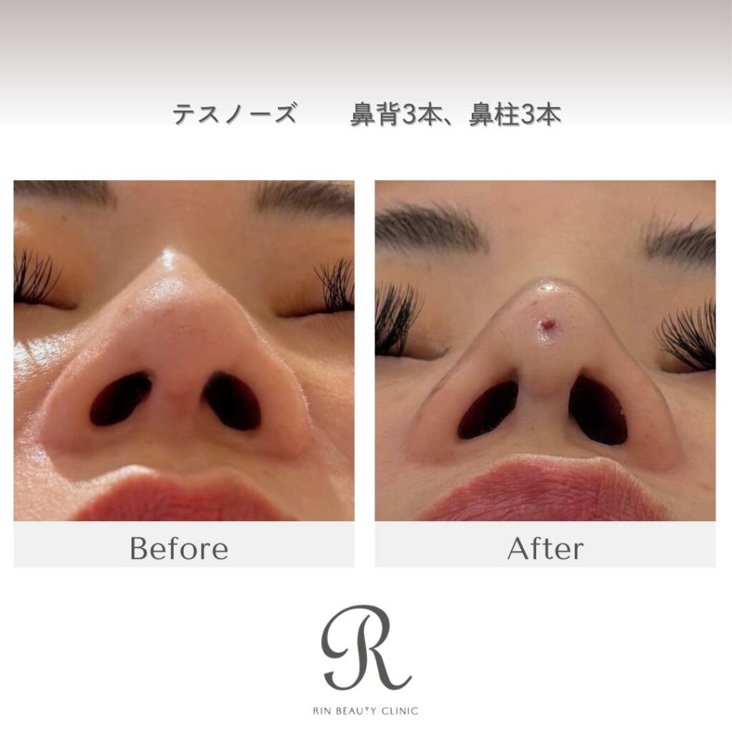 テスリフトノーズの症例写真