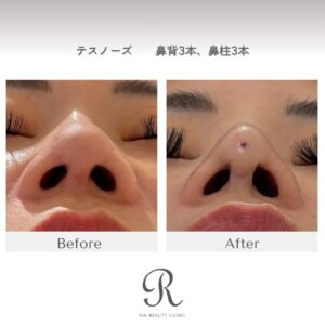 大阪心斎橋の美容皮膚科のテスリフトノーズ半額キャンペーン