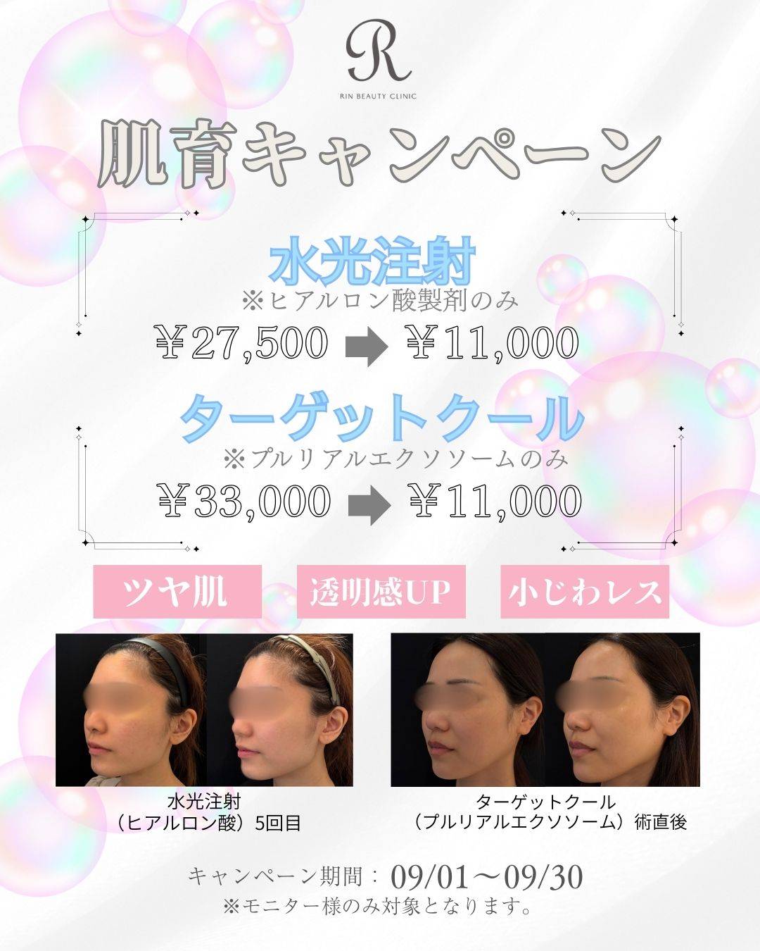 ターゲットクール、水光注射