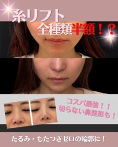 糸リフト　切らない鼻整形　モニター半額キャンペーン！　　　　　　　　　　　　　